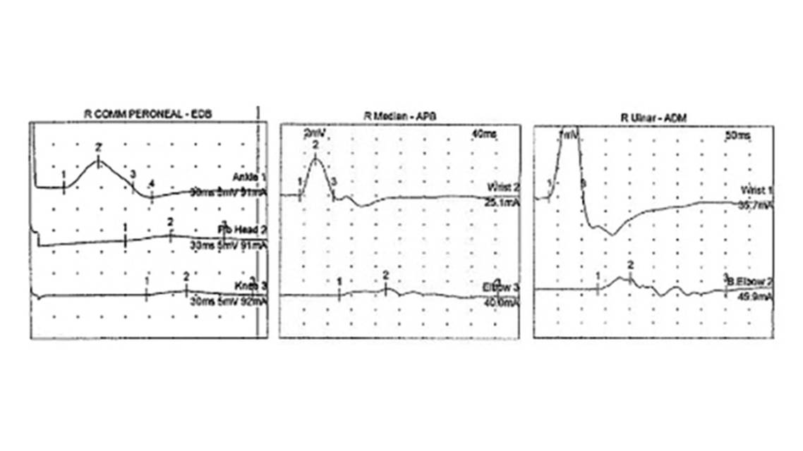 CIDP in an Adolescent After Pfizer BioNTech COVID 19 Vaccination