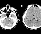 Familial Cerebral Cavernous Malformation