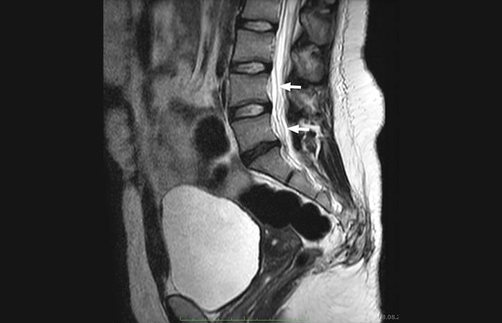Tuberculous Radiculomyelitis