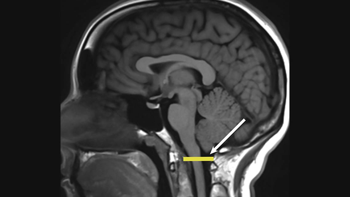 Understanding Chiari Malformations