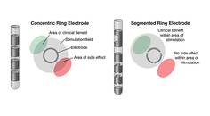 Movement Disorders Moment Deep Brain Stimulation in Movement Disorders Recent Advances and Future Directions