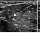 Neuromuscular Notes Neuromuscular Ultrasound in Polyneuropathy