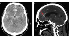 Case Report Cerebral Aneurysm Rerupture