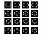Stroke Snapshot Incorporating Artificial Intelligence in Stroke Management Redefining State of the Art