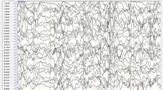 Epilepsy EssentialsInfantile Spasms The Biggest Little Seizures