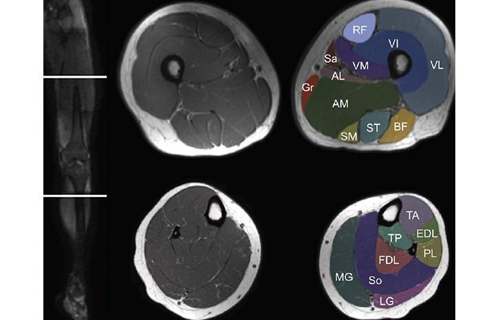 Muscle MRI for Neuromuscular Disorders