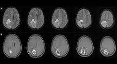 Focal Status Epilepticus 9 Years After Brain Abscess