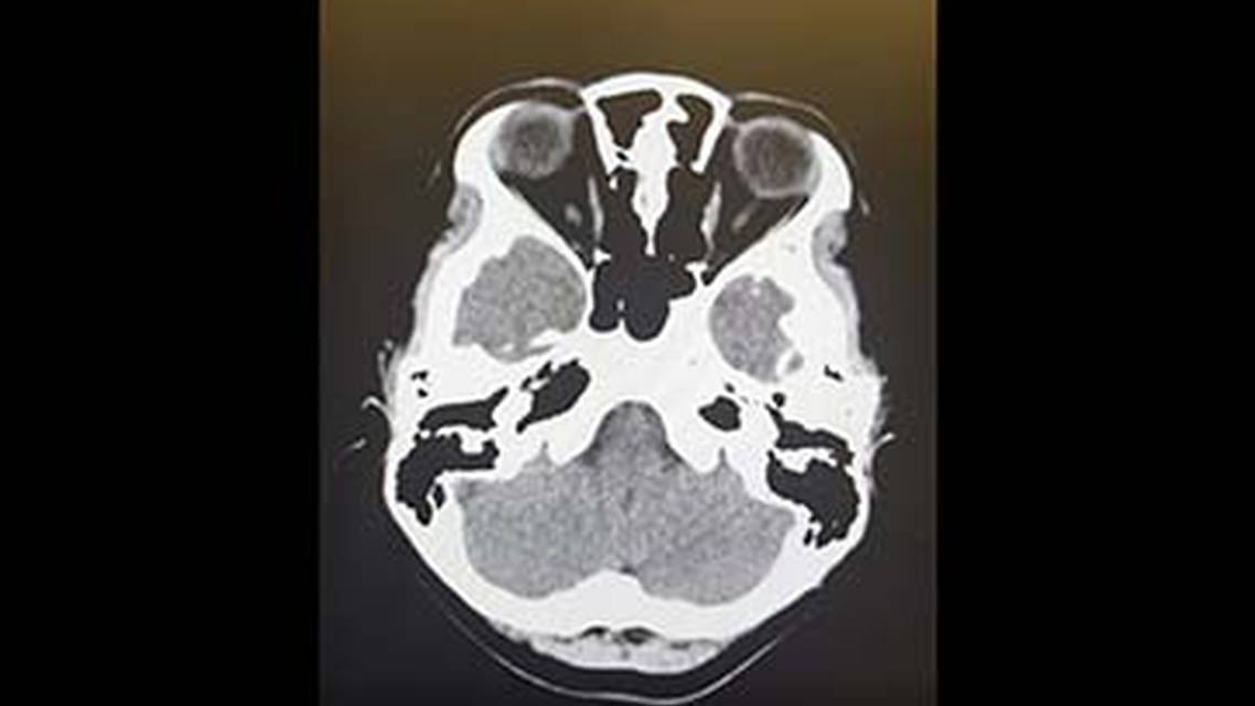 Headache Red Flags thumbnail