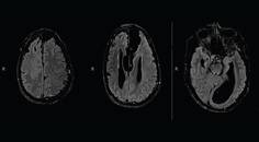 Return of Auras Following Treatment of Focal Onset Seizures with Responsive Neurostimulation