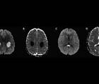 Recurrent Stroke Like Events Before Diagnosis of X Linked CharcotMarieTooth Disease