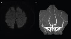 Case Report Reversible Cerebral Vasoconstriction Syndrome Presenting as Vasospastic Angina