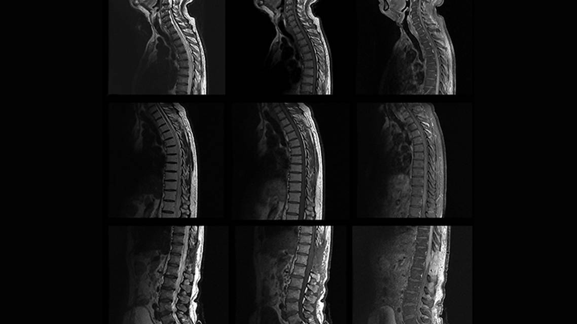 Case Report Occult Spinal Dural Arteriovenous Malformation