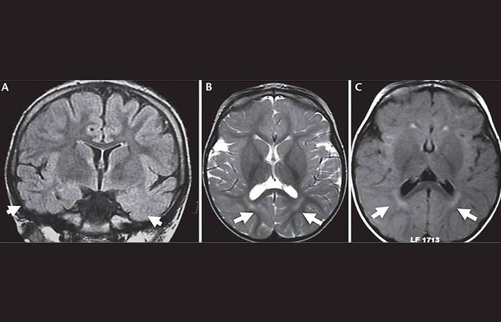 Early Onset Drug Resistant Epilepsy Due to Gene Variants