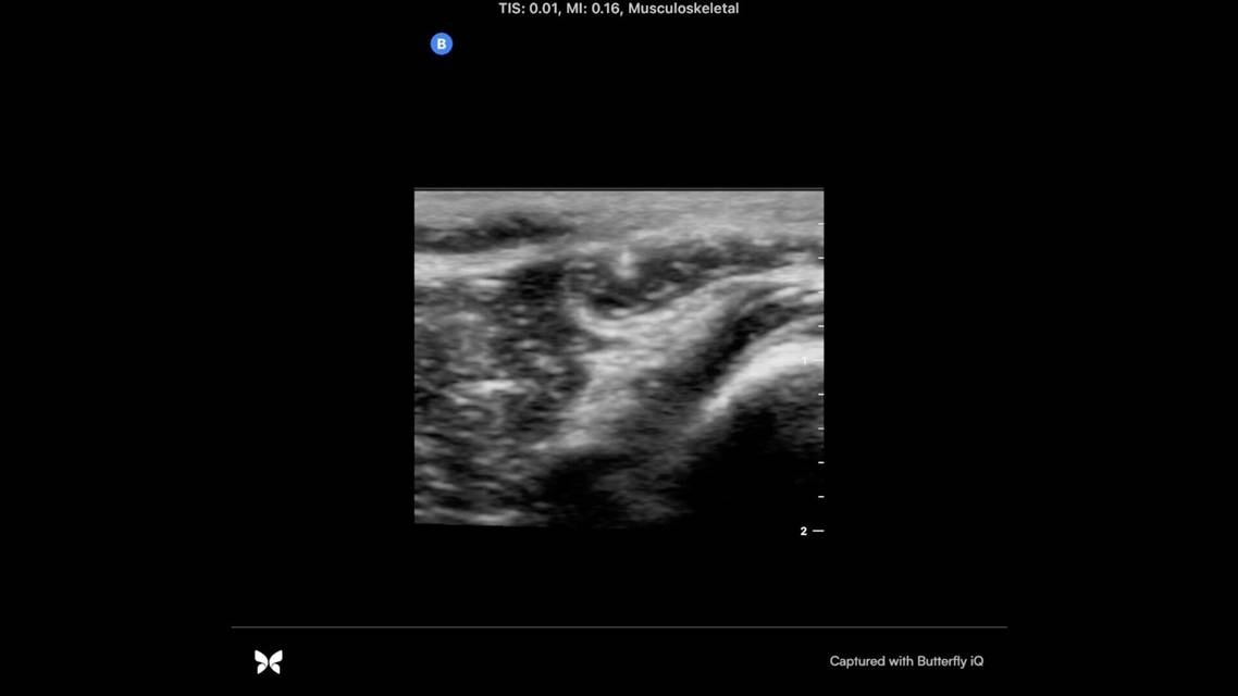 Botulin Toxin Injection thumbnail