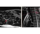 Case Report Complete Spinal Cord Injury