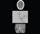Headache Horizons Reversible Cerebral Vasoconstriction Syndrome Presentation Diagnosis and Treatment of a Complex Neurova