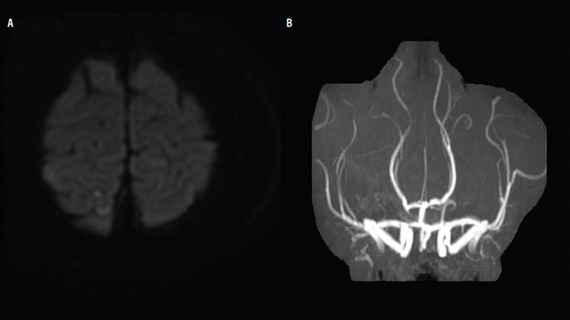 Case Report Reversible Cerebral Vasoconstriction Syndrome Presenting as Vasospastic Angina