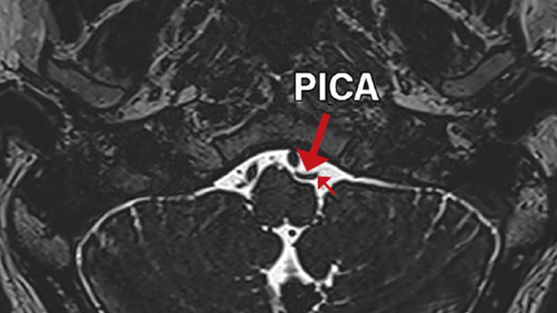Persistent Idiopathic Isolated Hypoglossal Nerve Palsy