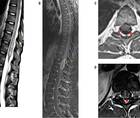 Neuromyelitis Optica Spectrum Disorder With Atypical Imaging Features