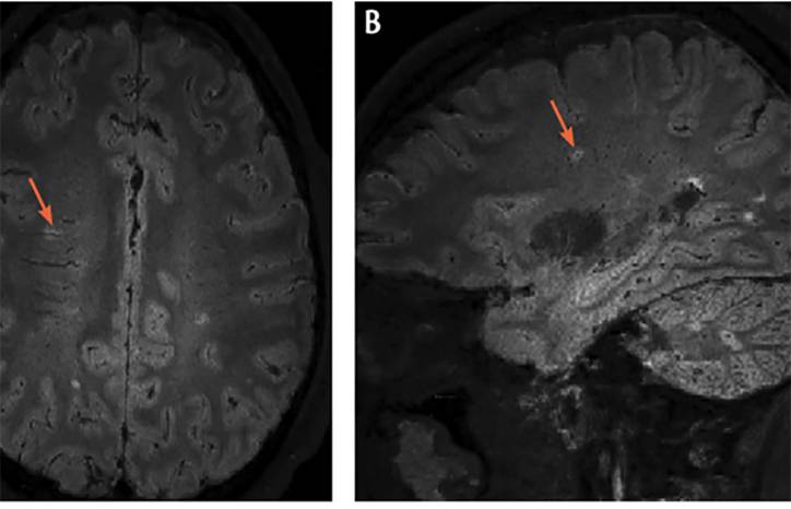 Multiple Sclerosis Minute The Central Vein Sign in Diagnosis of Multiple Sclerosis