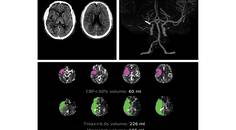 Stroke Snapshot Endovascular Thrombectomy for Stroke Treatment Outside the Established Criteria for Efficacy