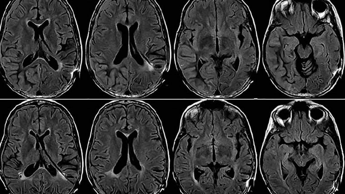 Seizures Visual Auras and Diffuse Cortical Enhancement