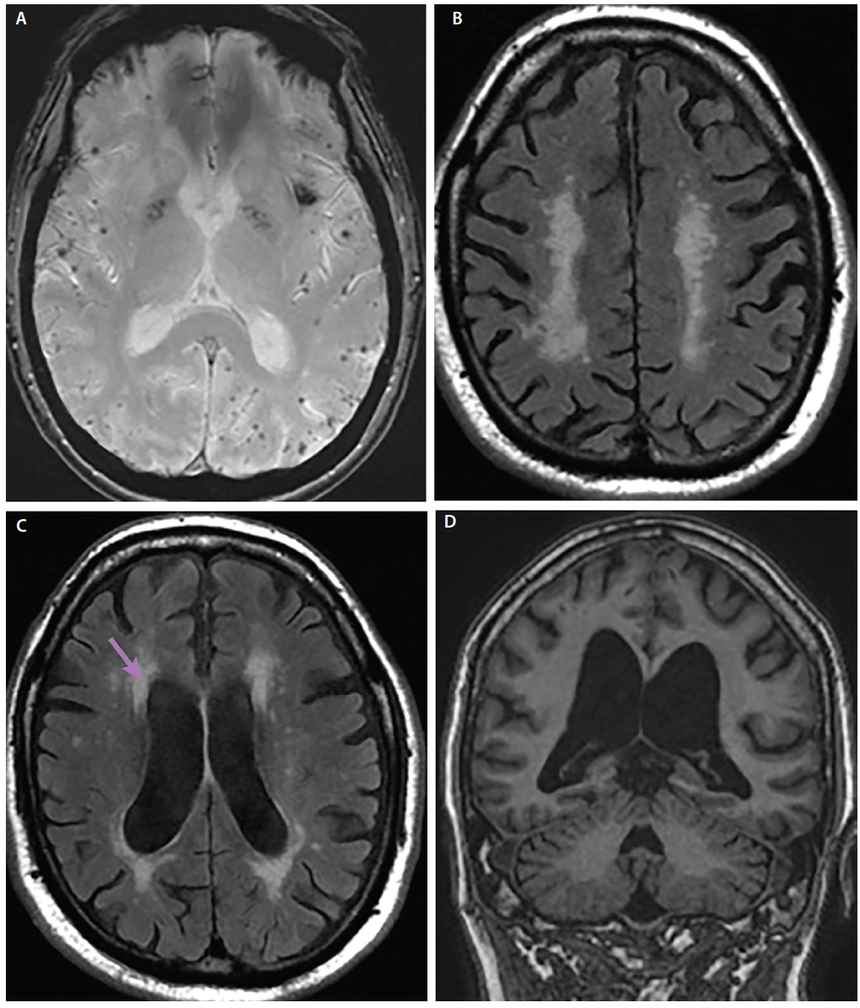 Neuroimaging and alzheimer s disease
