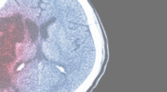 The Evolving Role of Neurologists in PFO Closure