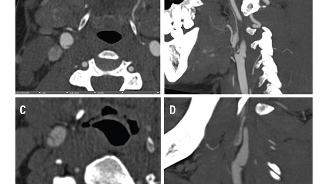 Stroke Snapshot Carotid Artery WebsEpidemiology and Pathophysiology
