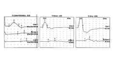 CIDP in an Adolescent After Pfizer BioNTech COVID 19 Vaccination