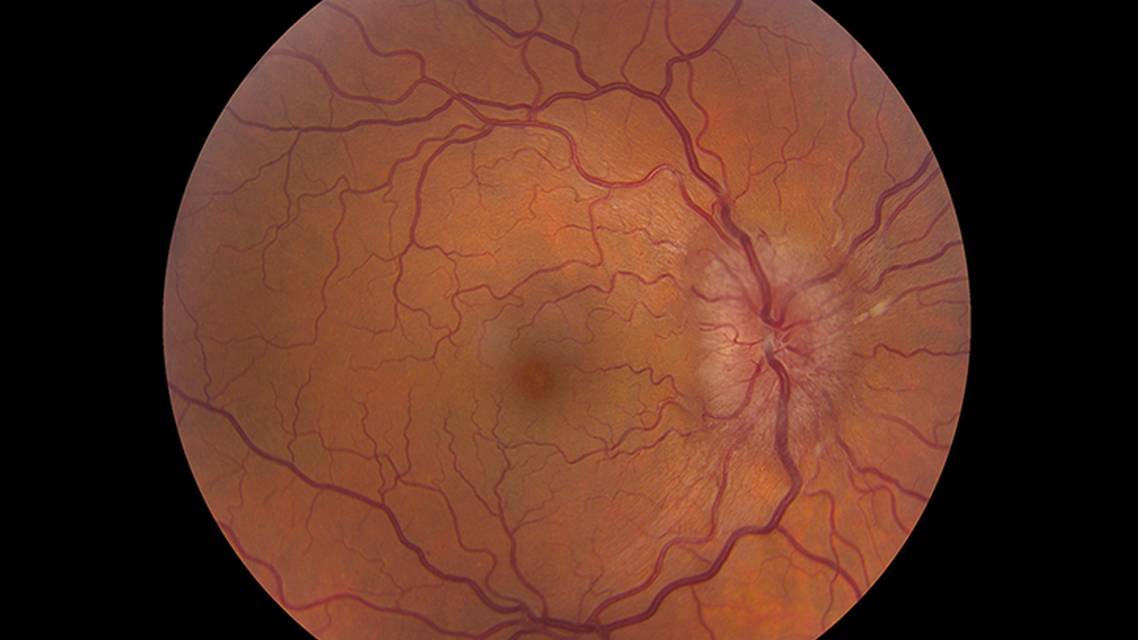 Pseudotumor Cerebri Syndrome Related to a Dural Arteriovenous Fistula After Vascular Trauma