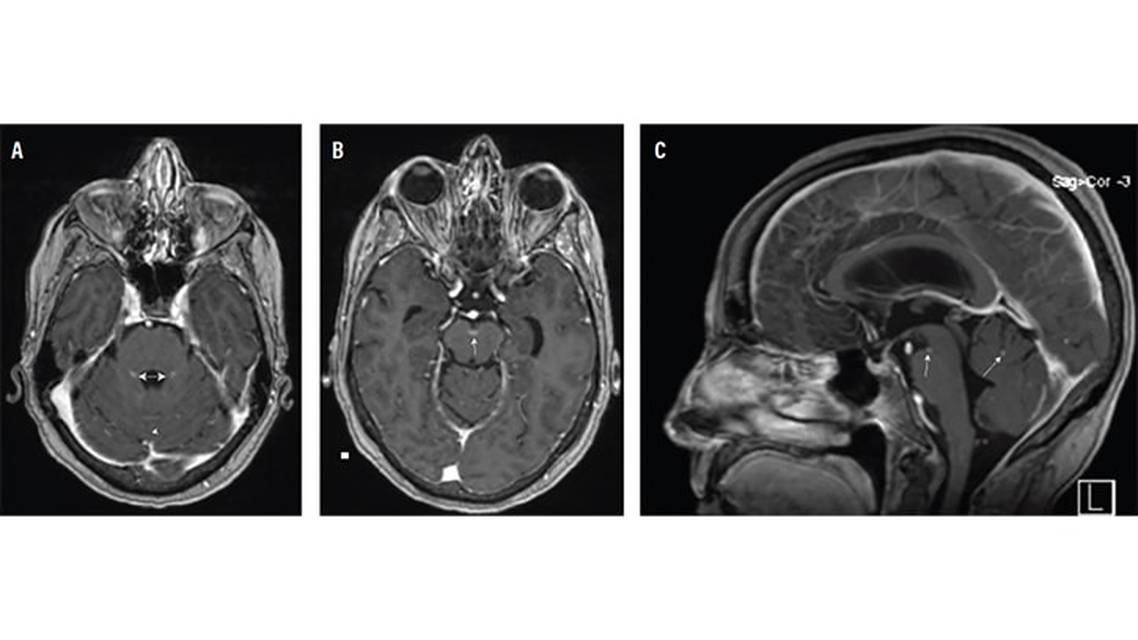 Rapidly Progressive Dementia Caused by Neoplastic Meningitis Attributable to Melanoma