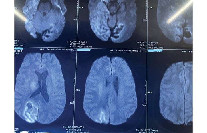 Disulfiram Ethanol Reaction Causing Cortical Blindness