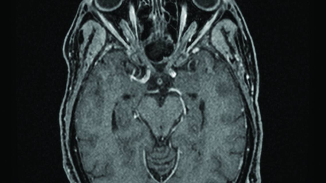 Perez Fig 2C Optic Nerve Image