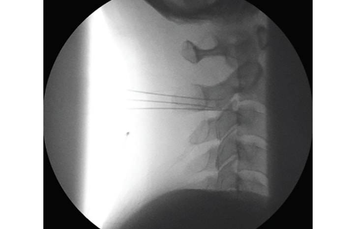 Occipital Neuralgia and Cervicogenic Headache