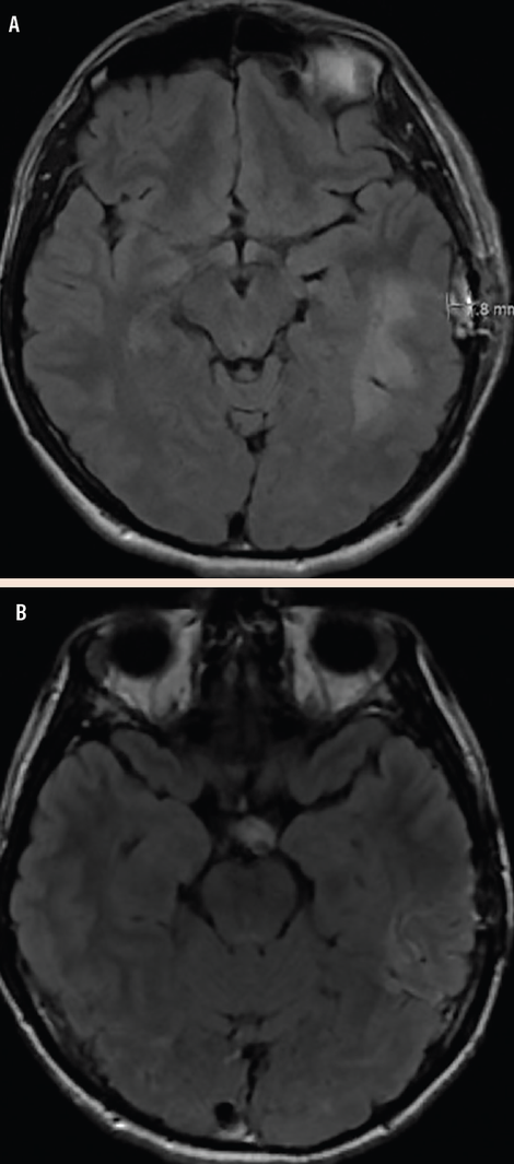 Challenge Case Report: PostCOVID-19 Encephalitis
