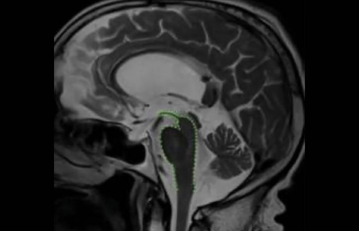 Atypical Parkinsonian Syndromes