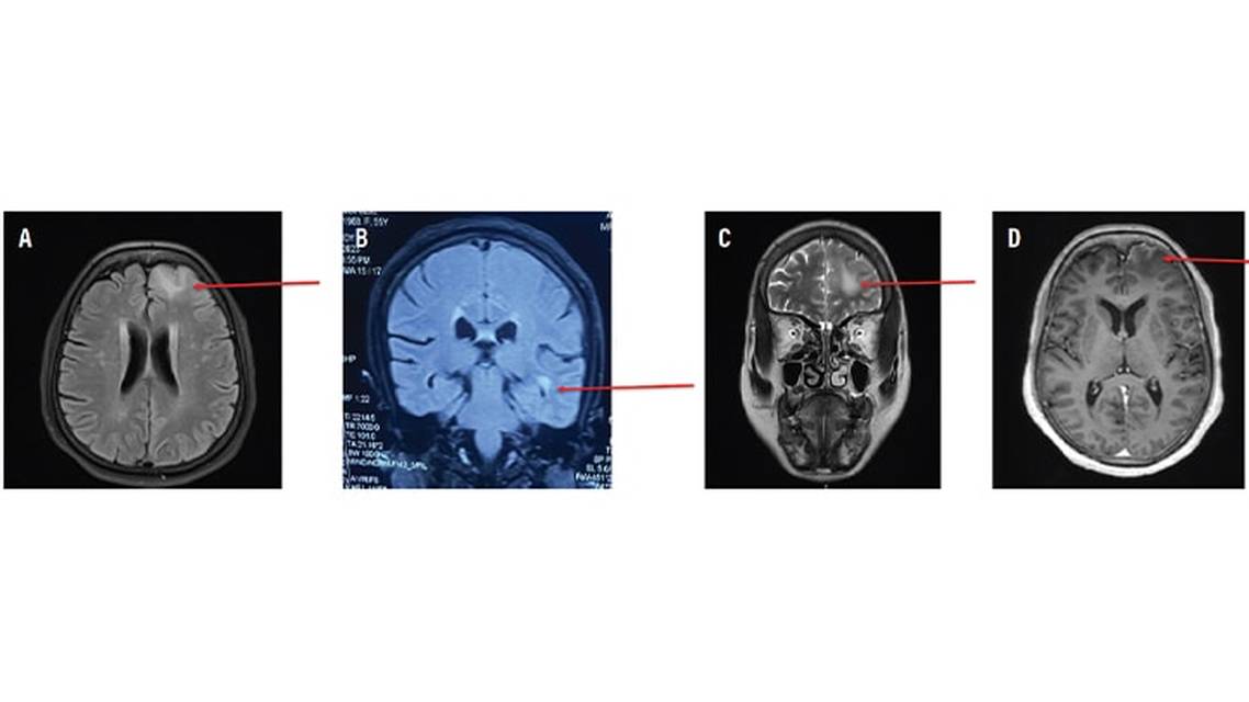 LGI1 Antibody Encephalitis Presenting as Focal Cortical Encephalitis