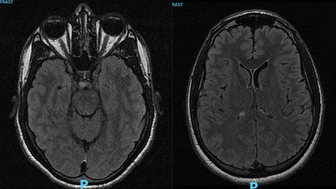 Reversible Cortical Blindness Secondary to Acute Carbon Monoxide Poisoning