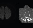 Case Report Reversible Cerebral Vasoconstriction Syndrome Presenting as Vasospastic Angina