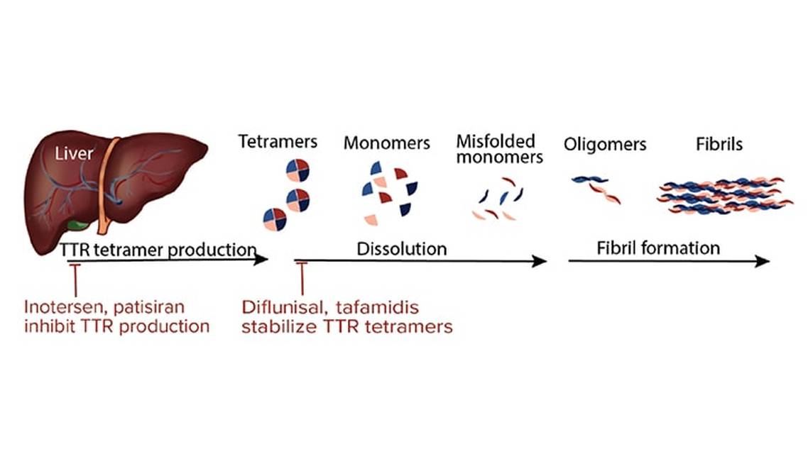Transthyretin Familal Amyloid Neuropathy