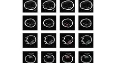 Stroke Snapshot Incorporating Artificial Intelligence in Stroke Management Redefining State of the Art