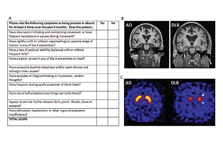 Lewy Body Dementia