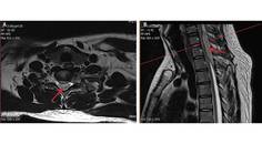 Case Report Complete Spinal Cord Injury