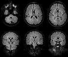 Acute Encephalopathy With Unusual Brain Lesions