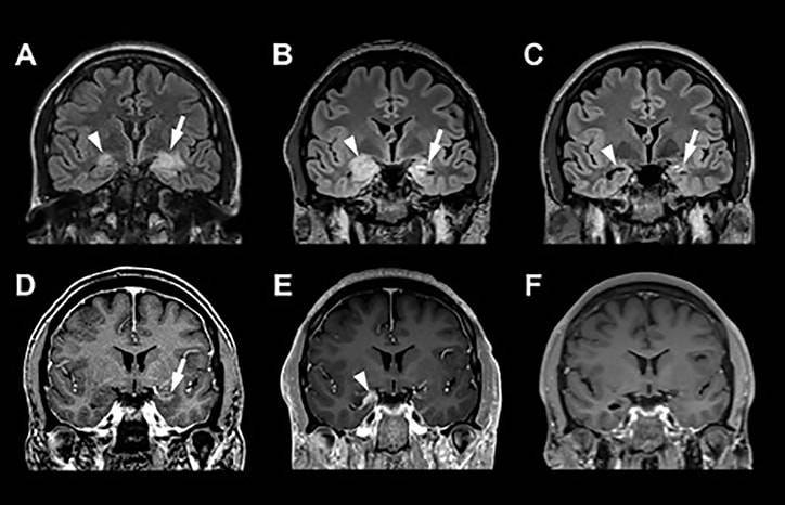 Autoimmune Associated Epilepsy