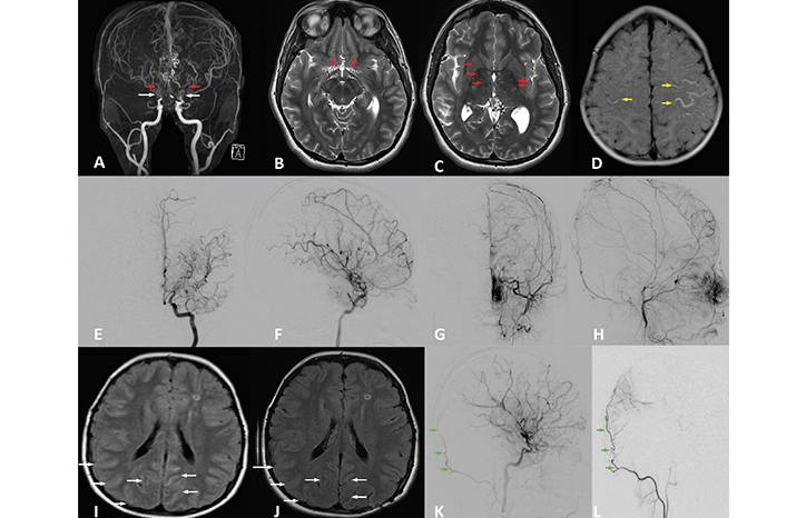 Moyamoya Disease