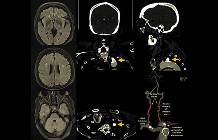 An Unusual Case of a Vertebrobasilar Transient Ischemic Attack Involving the Subclavian Steal Syndrome