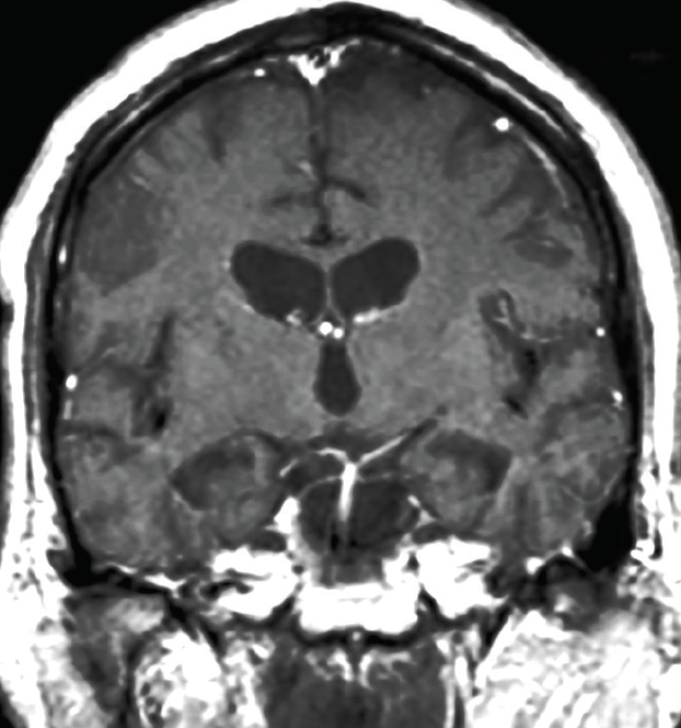 Neurosyphilis-Induced Psychosis