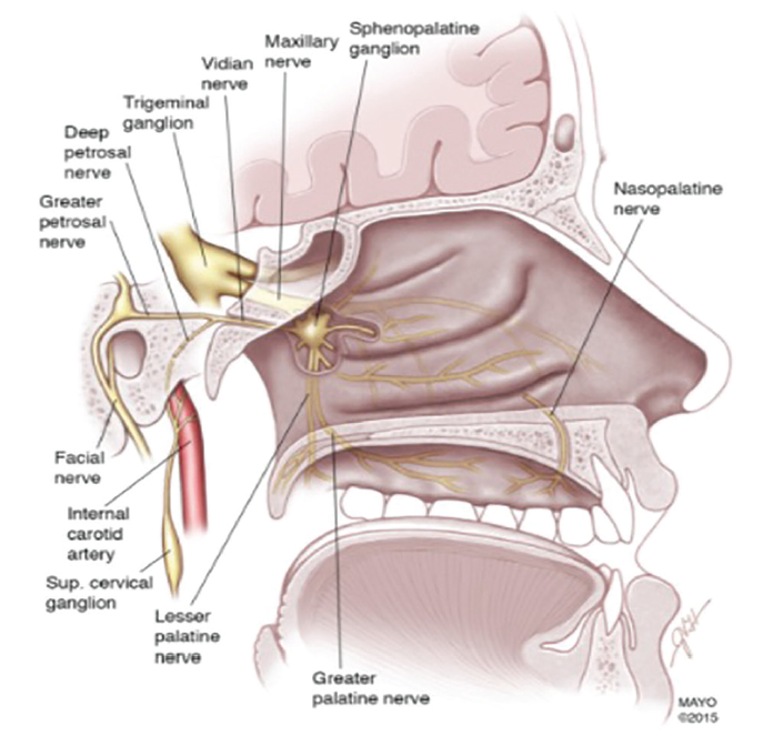 Sphenopalatine Ganglion Block Without Catheter